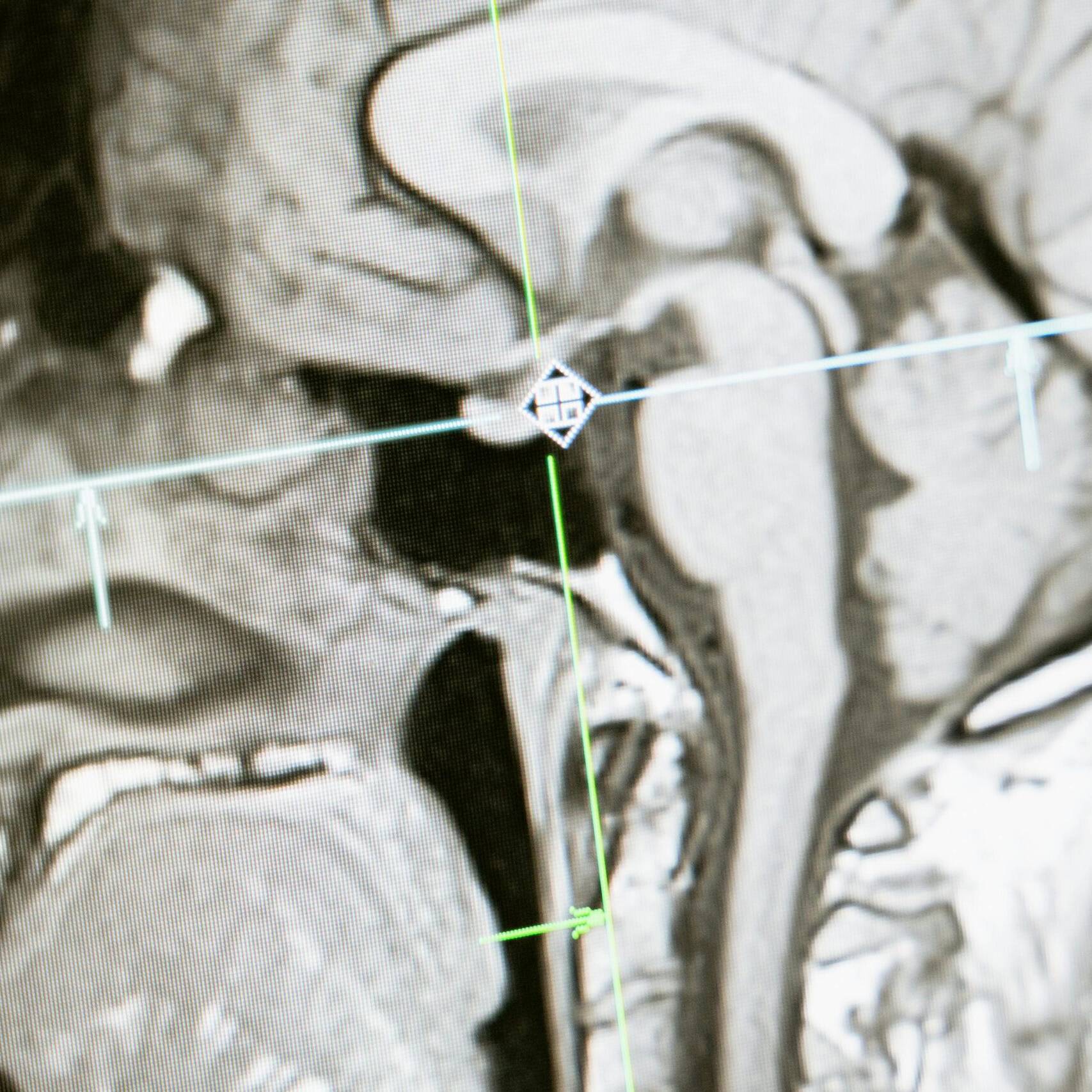 Close-up of an MRI scan showing a sagittal view of the human brain for analysis.