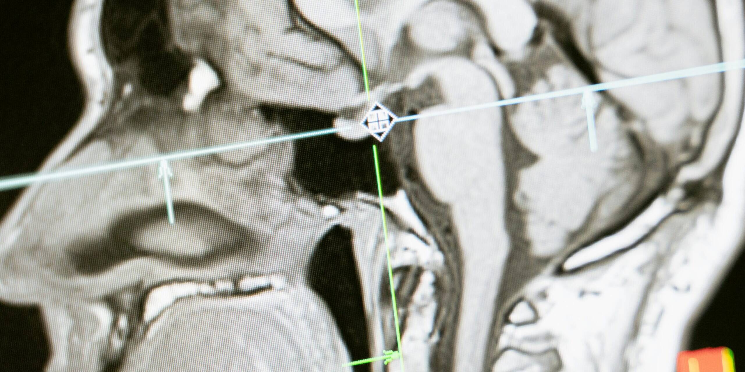 Close-up of an MRI scan showing a sagittal view of the human brain for analysis.