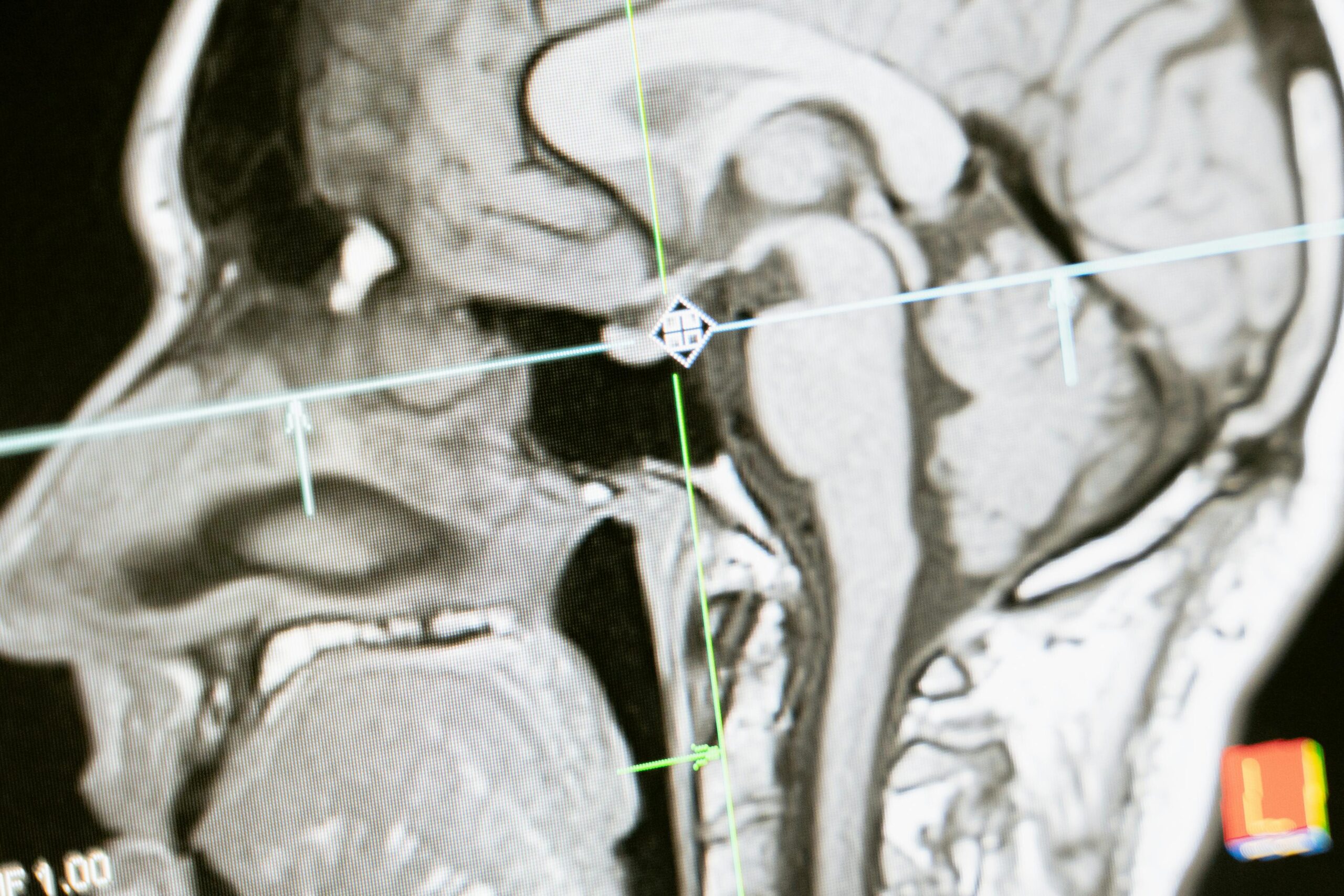 Close-up of an MRI scan showing a sagittal view of the human brain for analysis.